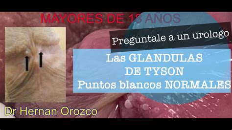 glandula de tyson|¿Por qué salen las glándulas de Tyson o bolitas。